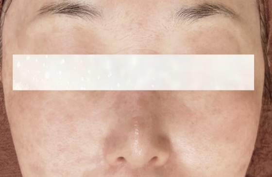 シミ美白改善コース