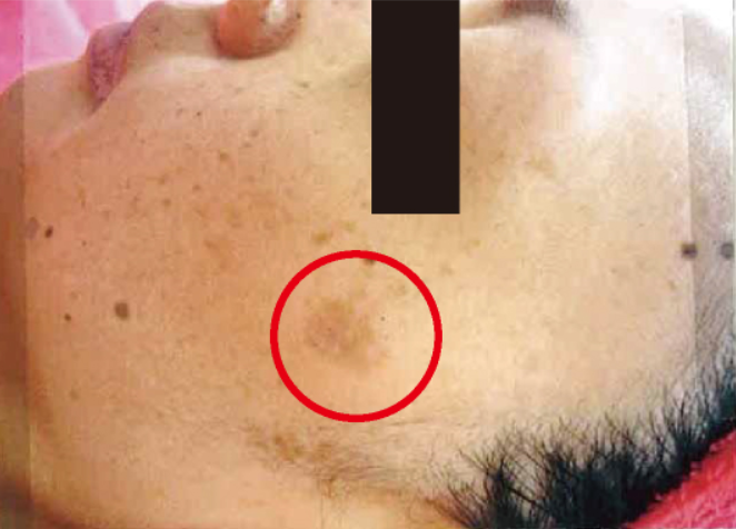 シミ美白改善コース