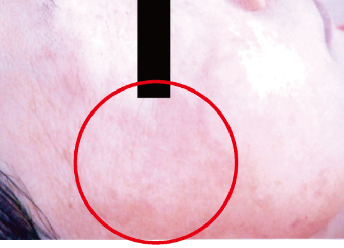 シミ美白改善コース