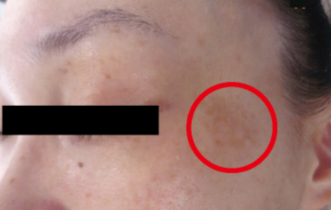 シミ美白改善コース