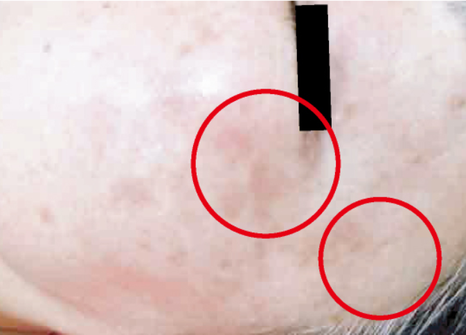 シミ美白改善コース