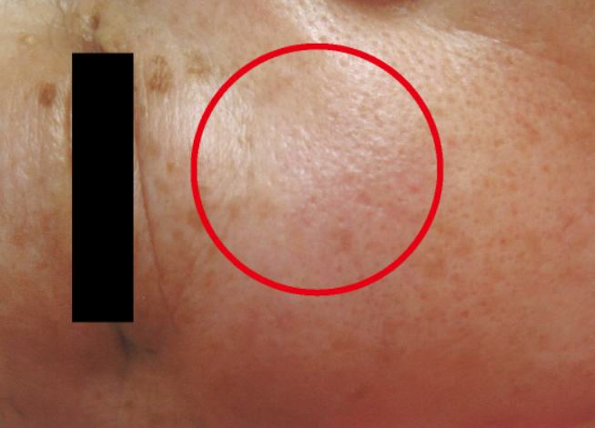 シミ美白改善コース