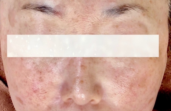 シミ美白改善コース