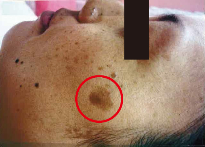 シミ美白改善コース