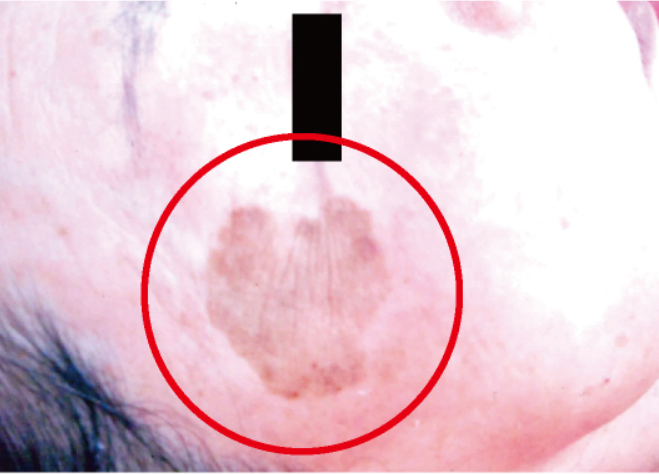 シミ美白改善コース