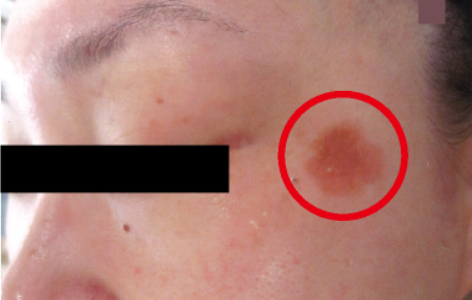 シミ美白改善コース