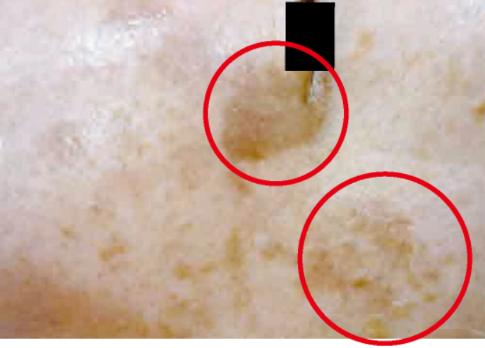 シミ美白改善コース