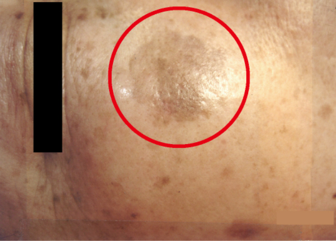 シミ美白改善コース